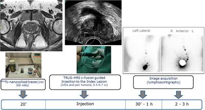 Sentinel Lymph Node Biopsy in Prostate Cancer Patients: Results From an Injection Technique Targeting the Index Lesion in the Prostate Gland